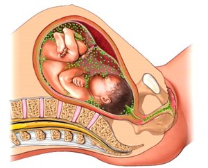 Хламидиоз при беременности: как распознать и вылечить?