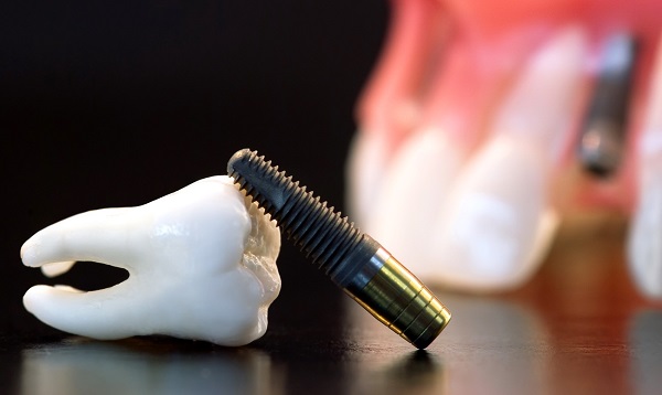 Имплантация зубов: специфика и возможные осложнения