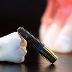 Имплантация зубов: специфика и возможные осложнения